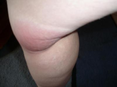 Bild zu Riesen Mückenstich,Allergie? - Baby Forum - Allgemeine Themen