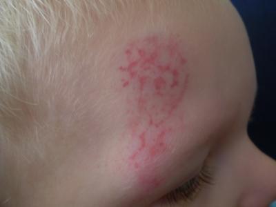 Bild zu mini ist hingefallen und sieht nun schlimm aus - Baby Forum - Allgemeine Themen