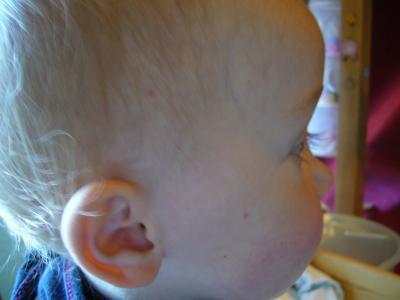 Bild zu Wo nach könnte das aussehen... diese Flecken hat er im Gesicht/ Kopf - Baby Forum - Allgemeine Themen