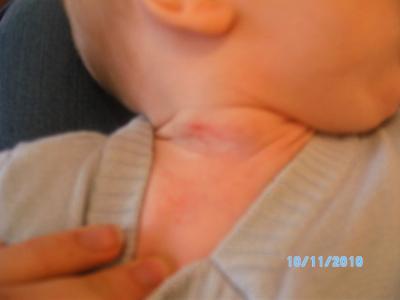 Bild zu muttermal?schwämmchen oder......?????????? - Baby Forum - Allgemeine Themen