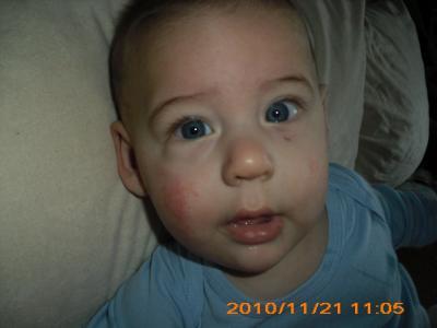 Bild zu Flecken im Gesicht??? +Bild - Baby Forum - Allgemeine Themen