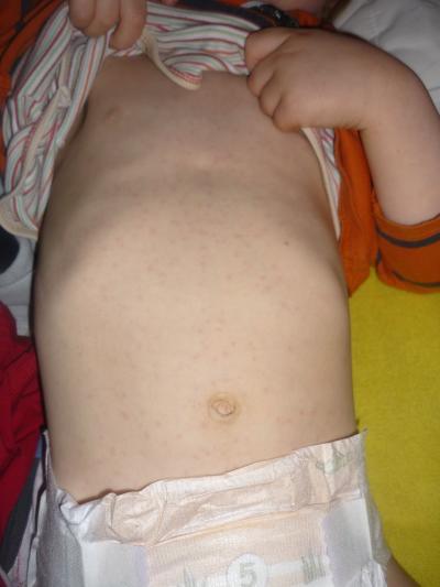 Bild zu Ausschlag durch Antibiotikum..? - Baby Forum - Allgemeine Themen