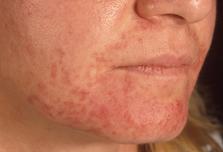 Bild zu Hatte jemand oder hat jemand eine "periorale Dermatitis"?? - Baby Forum - Allgemeine Themen