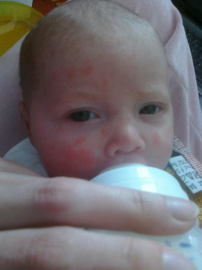 Bild zu Kennt das jemand!? Baby bekommt immermal rote Flecken!? - Baby Forum - Allgemeine Themen