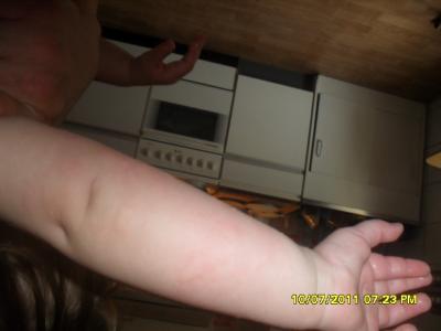 Bild zu meine kleine hat ausschlag am ganzen körper - Baby Forum - Allgemeine Themen