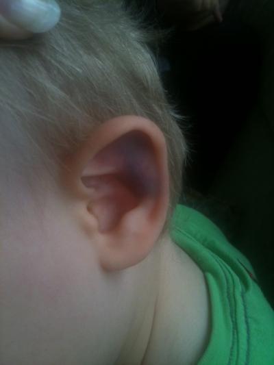 Bild zu Ich hatte ja keine Ahung das ein Ohr sooooo blau werden kann..... - Baby Forum - Allgemeine Themen