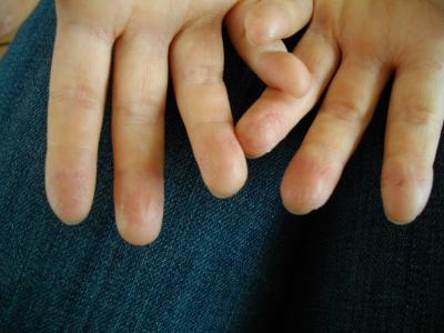 Bild zu Haut schrumpelig - löst sich .. !? - Baby Forum - Allgemeine Themen