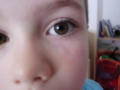 Bild zu Nesselsucht? Ausschlag?? (mit Foto) sry, bisschen lang - Baby Forum - Allgemeine Themen
