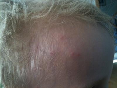 Bild zu Beulen - Update - Baby Forum - Allgemeine Themen