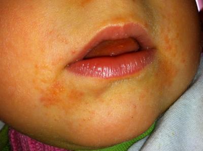 Bild zu Komischer ''Ausschlag'' um den Mund bei Kleinkind - Baby Forum - Allgemeine Themen