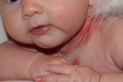 Bild zu Neurodermitis -was hat euren Kindern geholfen? - Baby Forum - Allgemeine Themen