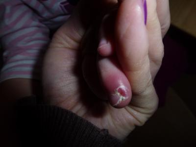 Bild zu Finger rot und offen, schlimm? - Baby Forum - Allgemeine Themen