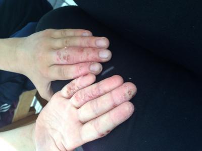 Bild zu Neurodermitis -Schub ... - Baby Forum - Allgemeine Themen