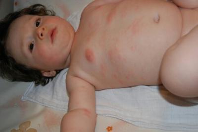 Bild zu Neurodermitis bei Baby - Baby Forum - Allgemeine Themen