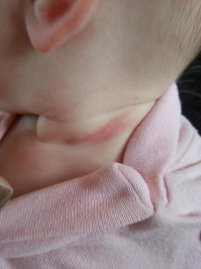 Bild zu Gestern hat der Hals meiner kleinen so ausgesehen als ich sie abholte!!!! - Baby Forum - Allgemeine Themen