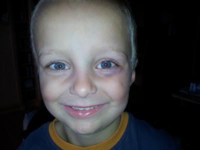 Bild zu Kindergarten-Unfall - Baby Forum - Allgemeine Themen