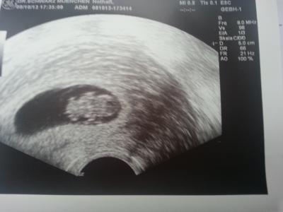 Bild zu Ultraschall - Baby Forum - Allgemeine Themen