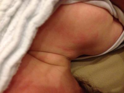Bild zu Ausschlag bei Fieber - Baby Forum - Allgemeine Themen