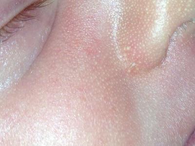 Bild zu Roter Fleck - Baby Forum - Allgemeine Themen