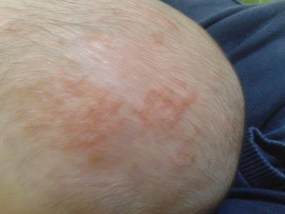Bild zu Was ist das? Ausschlag? Milchschorf? - Baby Forum - Allgemeine Themen