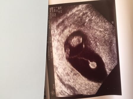 Bild zu Schaut euch das Us Foto an......warum Dottersack soweit weg?? - Baby Forum - Allgemeine Themen