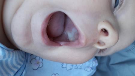 Bild zu Mundsoor - Baby Forum - Allgemeine Themen