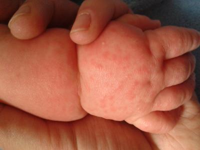Bild zu Hilfe. Mein Sohn hat rote pöckchen auf der Haut. - Baby Forum - Allgemeine Themen