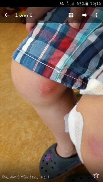 Bild zu Infizierte Insektenstiche?Hat jemand Erfahrung? - Baby Forum - Allgemeine Themen