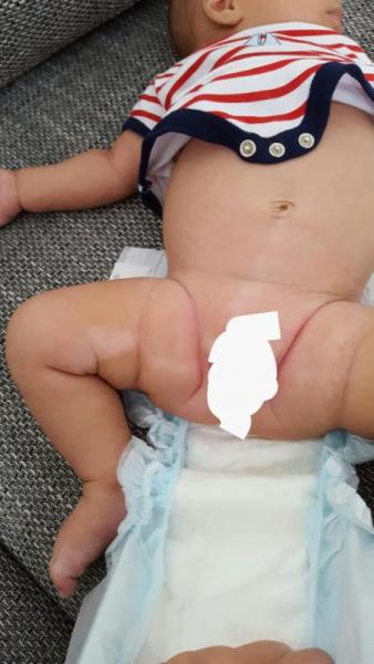 Bild zu Wie schnell verbreitet sich vitiligo?wird mein baby ganze körper gesicht weisse - Baby Forum - Allgemeine Themen