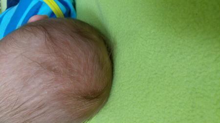 Bild zu Kopfgneis oder milchschorf? - Baby Forum - Allgemeine Themen