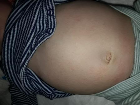Bild zu Ausschlag am Bauch - Baby Forum - Allgemeine Themen