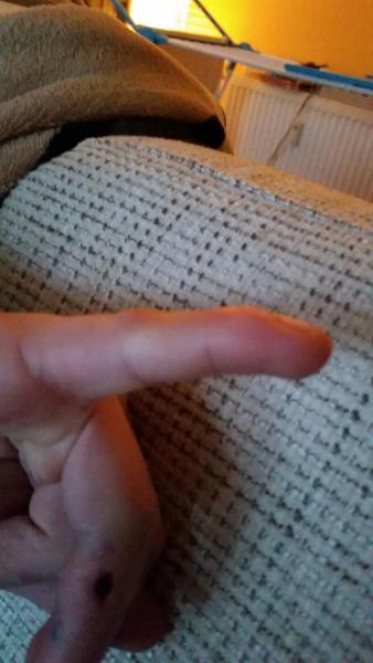 Bild zu vor etwa 3 Wochen Finger verletzt - Baby Forum - Allgemeine Themen