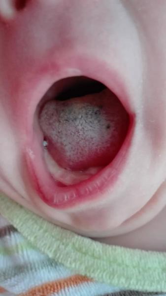 Bild zu Hartnäckiger Zungenbelag -was tun? - Baby Forum - Allgemeine Themen