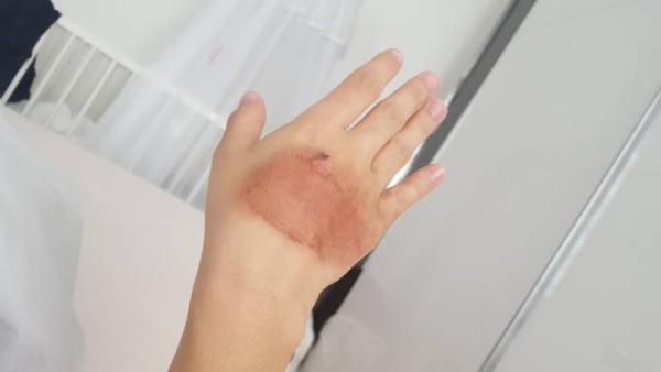 Bild zu So sieht meine Verbrennung jetzt aus.. - Baby Forum - Allgemeine Themen