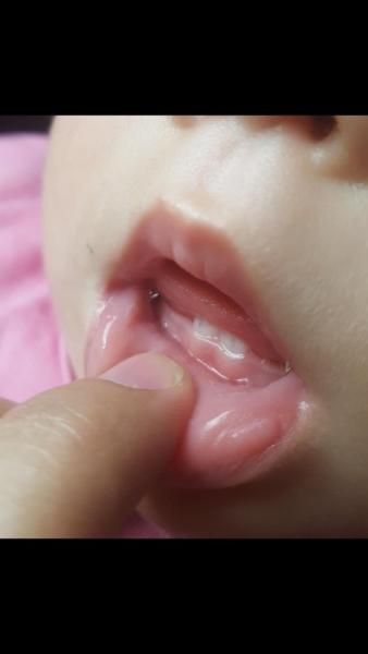 Bild zu Ganz dünner grauer strich vorderzähne. Schaut mal.Bitte - Baby Forum - Allgemeine Themen