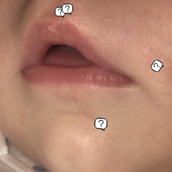 Bild zu Auch Neugeborenenakne? - Baby Forum - Allgemeine Themen