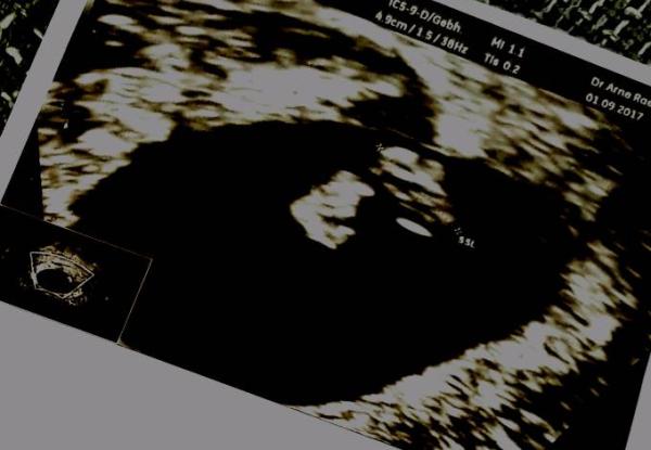 Bild zu Dottersack oder zwei? - Baby Forum - Allgemeine Themen