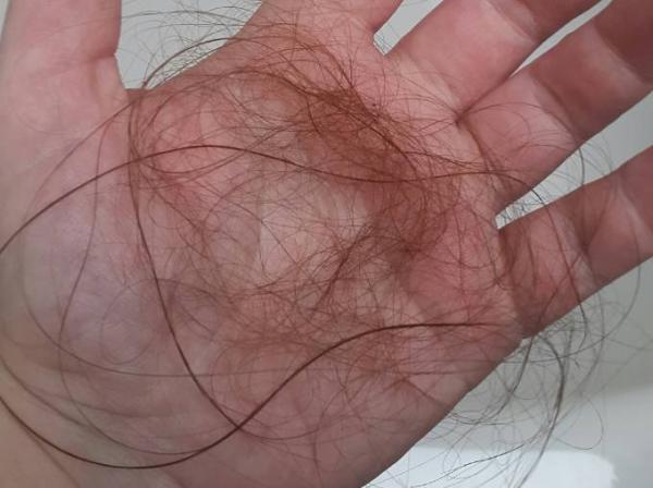 Bild zu Extremer Haarausfall - Baby Forum - Allgemeine Themen
