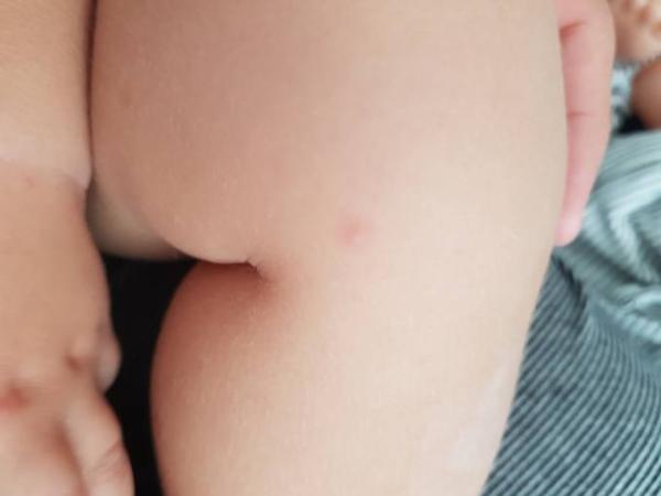 Bild zu Ist das ein Ausschlag ? - Baby Forum - Allgemeine Themen