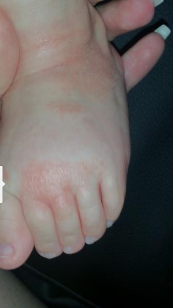 Bild zu Flecken auf der haut - Baby Forum - Allgemeine Themen