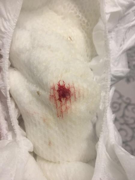 Bild zu Blut in der windel - Baby Forum - Allgemeine Themen