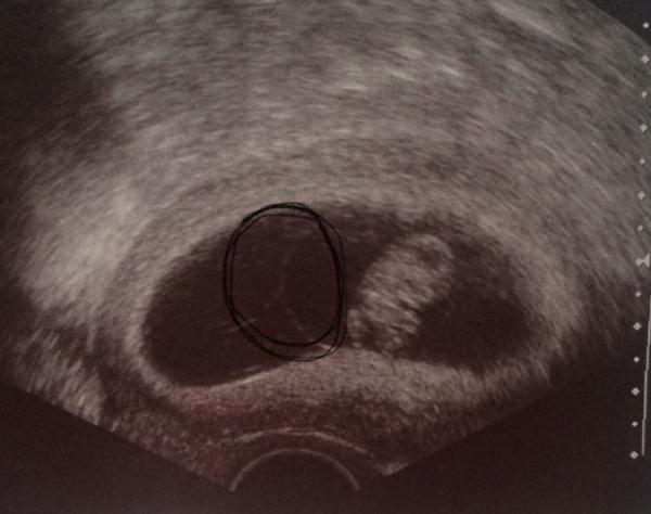 Bild zu Könnten es Zwillinge sein ? - Baby Forum - Allgemeine Themen