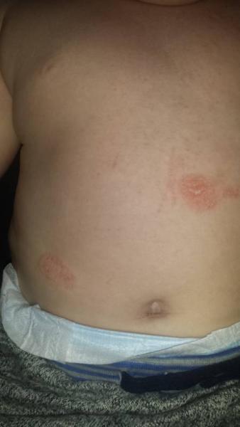 Bild zu Ich nochmal wegen Hautproblem... - Baby Forum - Allgemeine Themen