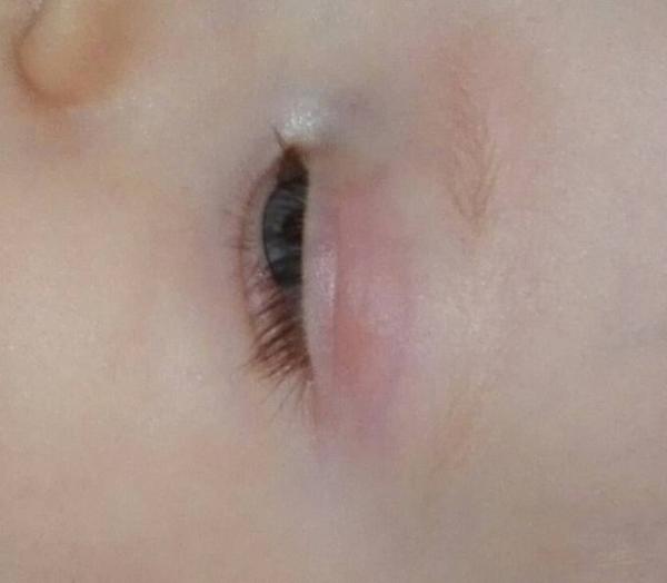 Bild zu Geschwollenes Augenlid - Baby Forum - Allgemeine Themen