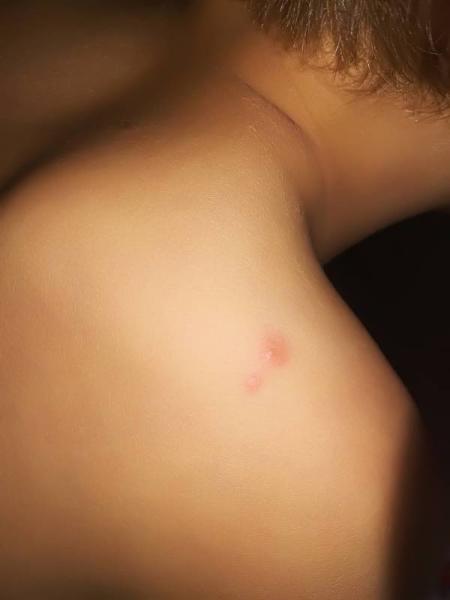 Bild zu Was sind das für Stiche? - Baby Forum - Allgemeine Themen