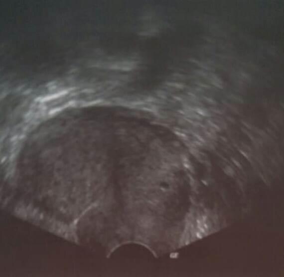 Bild zu SS Anzeichen, US kleiner schwarzer Fleck, nicht SS ? - Baby Forum - Allgemeine Themen