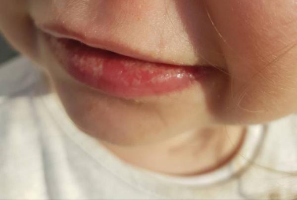 Bild zu Ist das Mundsoor? - Baby Forum - Allgemeine Themen