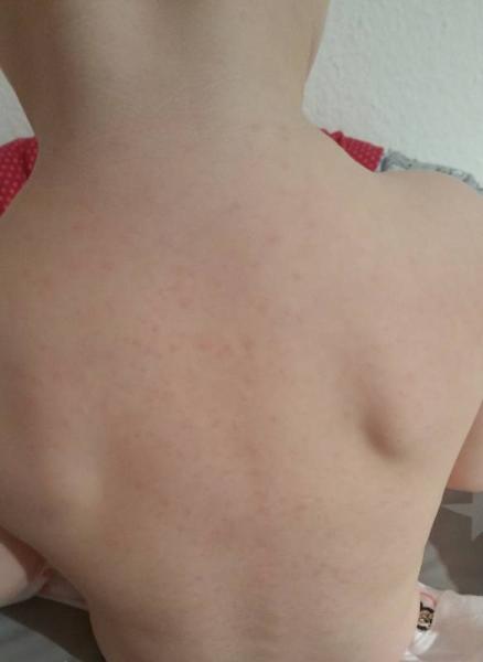 Bild zu Hilfe Ausschlag - Baby Forum - Allgemeine Themen