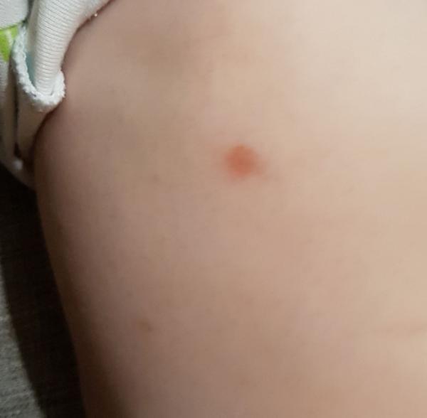 Bild zu Rote Flecken bei Baby - Baby Forum - Allgemeine Themen