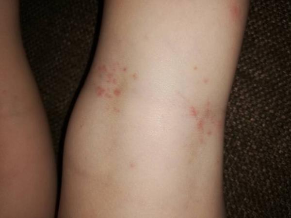 Bild zu Rote Pickelchen in Kniekehle - Baby Forum - Allgemeine Themen